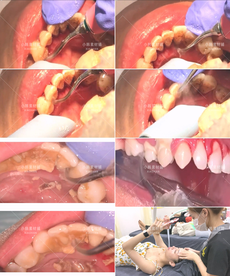 生活解压纪录片清洗牙结石全1季中视频自媒体解说高清视频素材插图8
